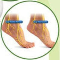 Neuropatia Diabética